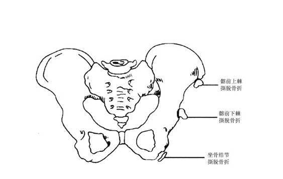 骨盆骨折的护理方式