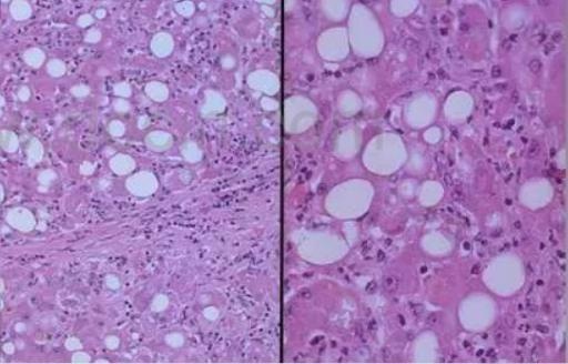 光镜下每单位面积见>30%的肝实质细胞出现脂变,称为脂肪性肝病,简称脂