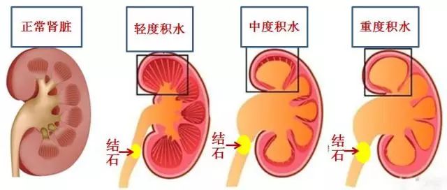 肾积水图片位置示意图图片