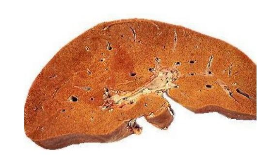 脂肪肝标本图片