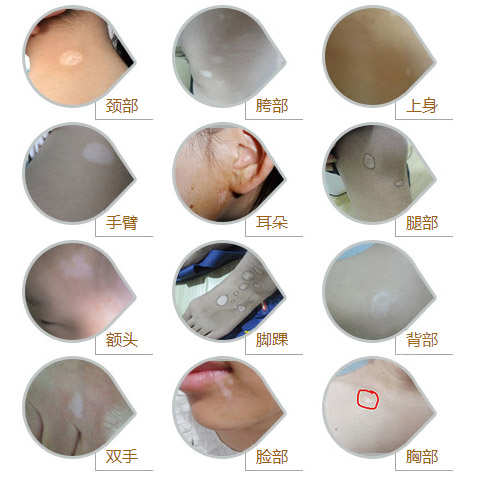 溫馨提示:白斑並不可怕,一定要用積極的心態,做好正確的處理,積極配合