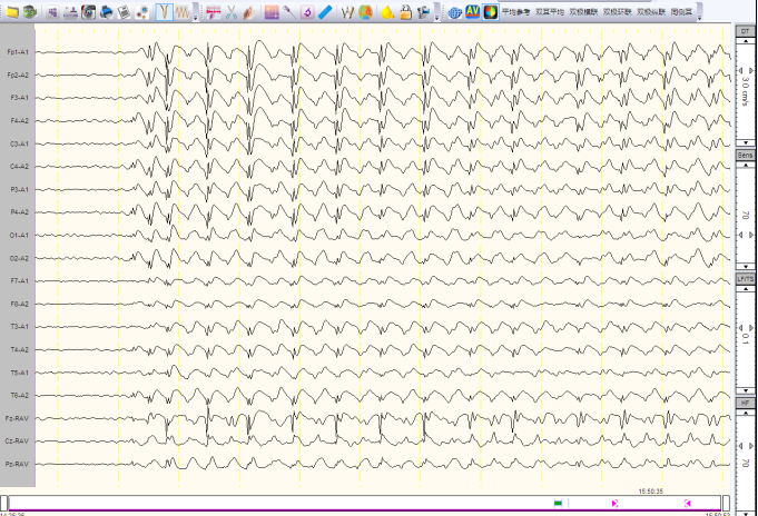 儿童良性癫脑电图图片