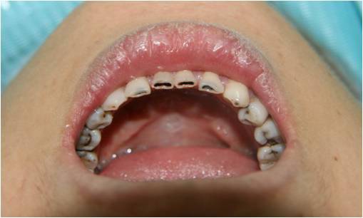 牙体牙髓常见病(上)