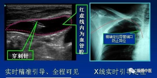 米老鼠征超声图片图片