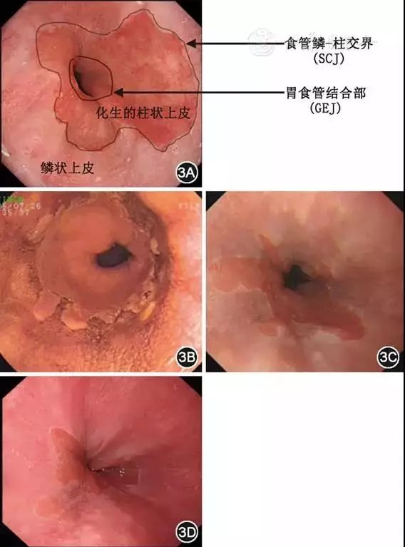 胃的齿状线图片图片