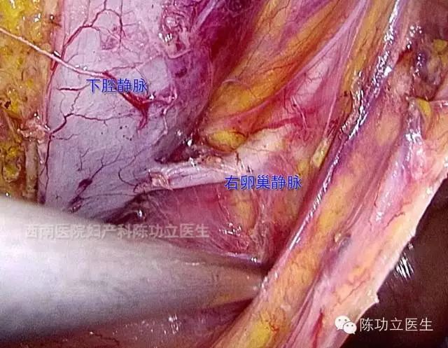 清掃腸繫膜下動脈附近淋巴結需注意避免損傷左側輸尿管,腰動靜脈和上