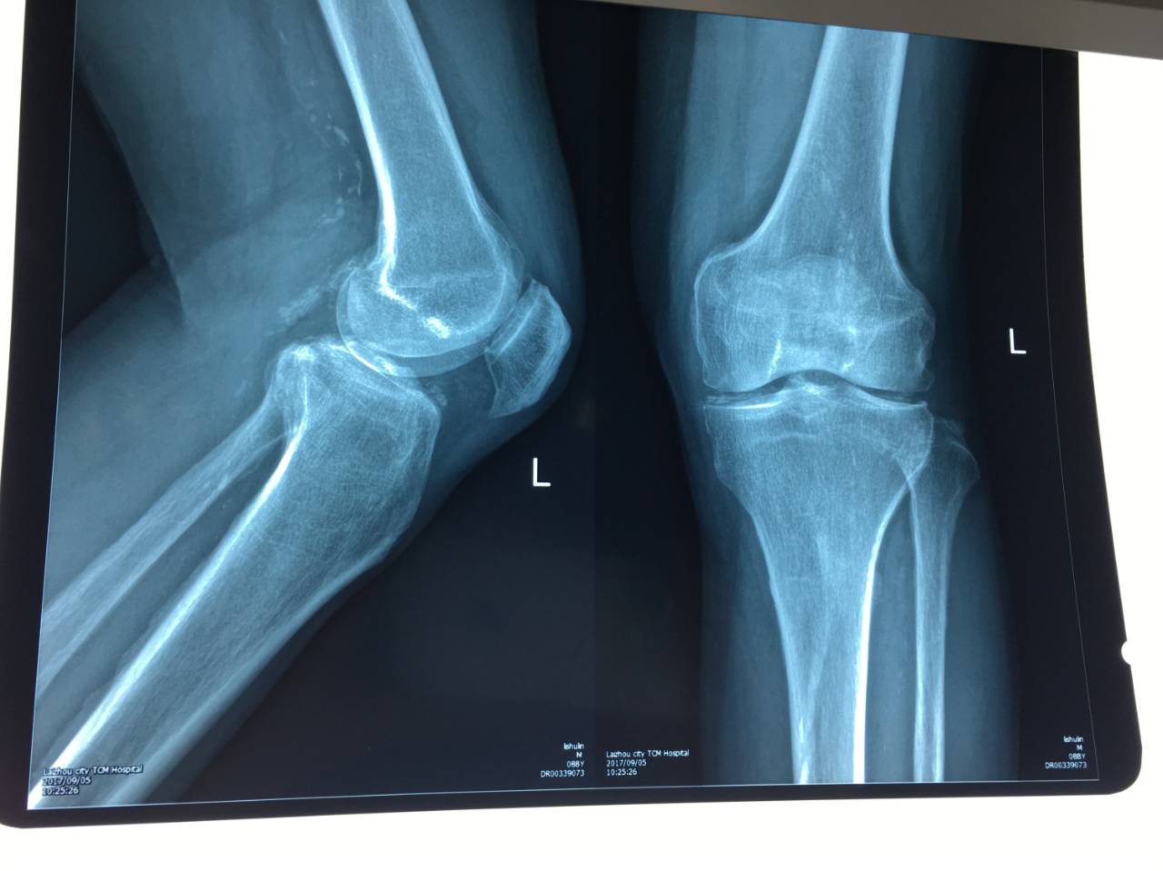 病人的x線檢查:右膝髕上囊,髕下深囊積液,股骨內外側髁及脛骨外側髁骨