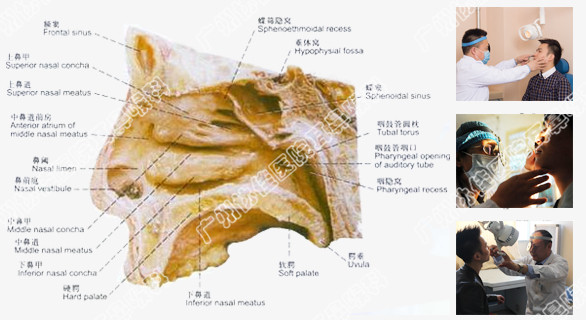 鼻腔囊腫治得好嗎 廣州協佳耳鼻喉