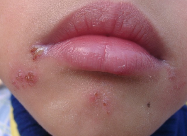 患者口角及下颌处见四处局限性群集小水疱1,热疮(单纯疱疹)来源:医学