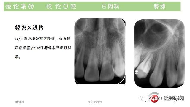 牙龈癌图片晚期 x光片图片