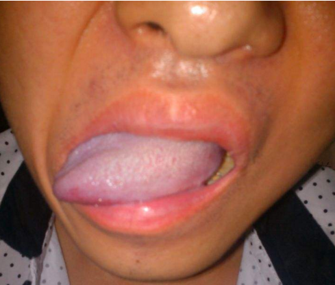 胃癌舌头图片症状图片