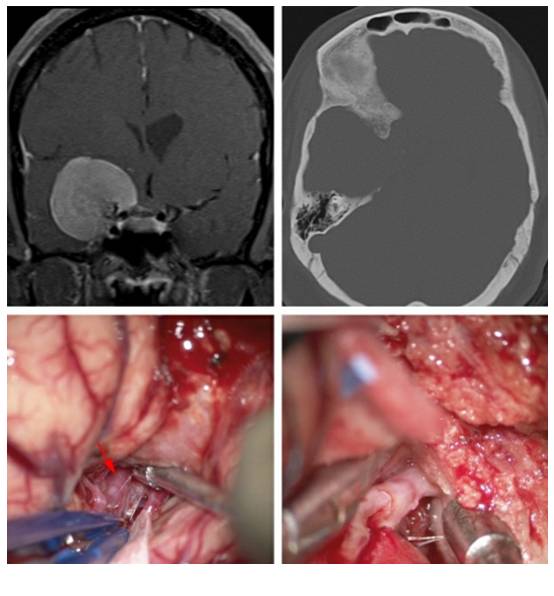 蝶骨嵴内侧型脑膜瘤手术技巧丨the neurosurgical atlas全文翻译