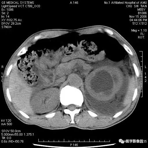 增強掃描實質期見腎前,腎後筋膜增厚並強化(↑),囊液不強化;c.