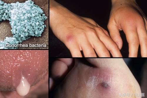 4 / 16 淋病疥疮是一种由小螨虫在人类皮肤上产卵引起的瘙痒感染