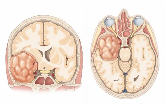 脑膜瘤位置图解图片