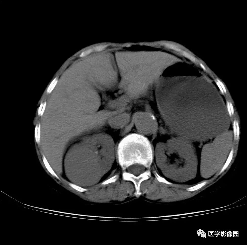 第七章泌尿生殖系統第二節泌尿系統病變二泌尿系統惡性腫瘤一腎癌丨