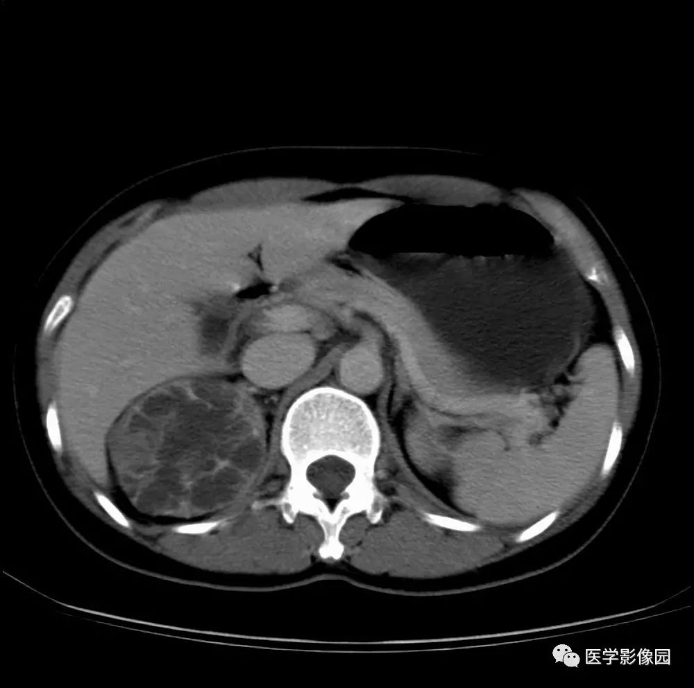 第七章泌尿生殖系統第二節泌尿系統病變二泌尿系統惡性腫瘤一腎癌丨