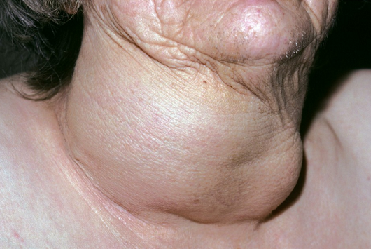 甲状腺瘤的早期症状图图片