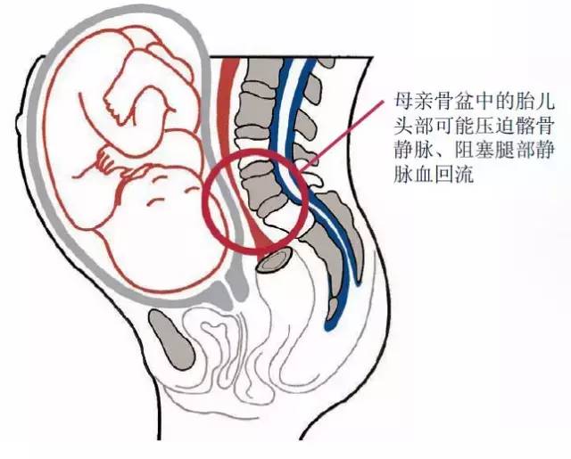 手脚浮肿的原因主要是由于妊娠子宫增大,压迫静脉,造成静脉回流受阻