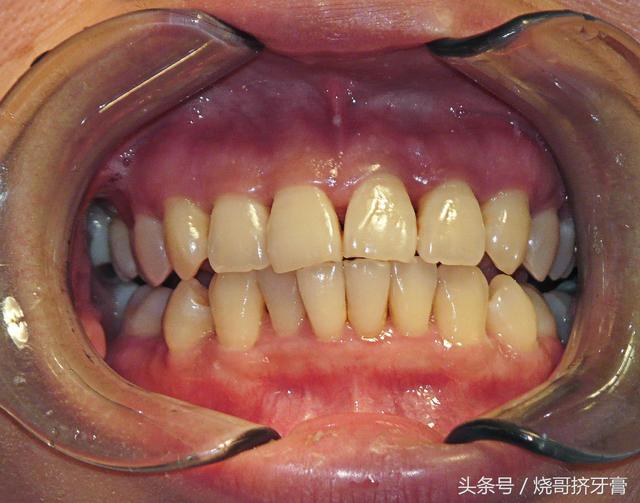 洗牙后牙龈萎缩真的治不好吗?