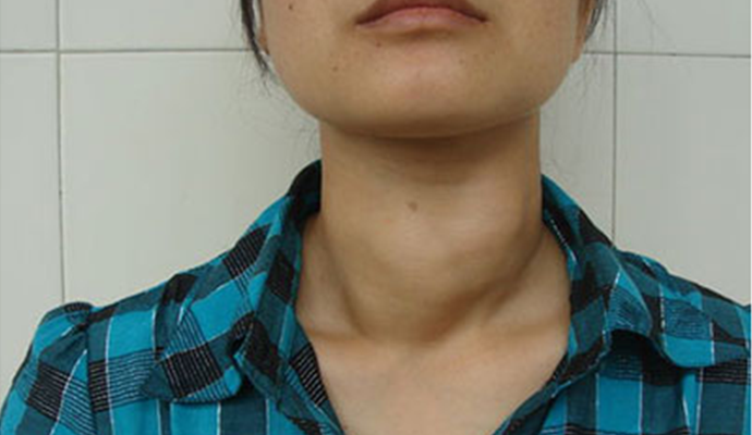 甲状腺初期图片图片
