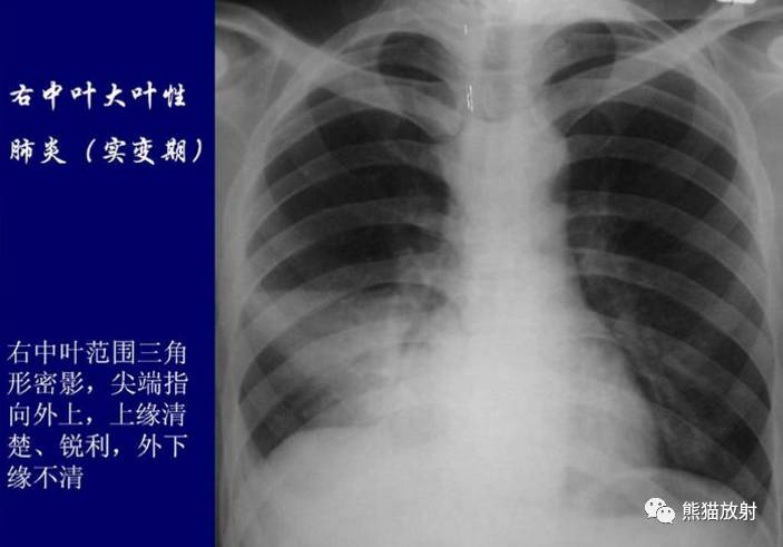 【x线诊断要点】大叶性肺炎,支气管肺炎,球形肺炎,机化性肺炎,炎性假