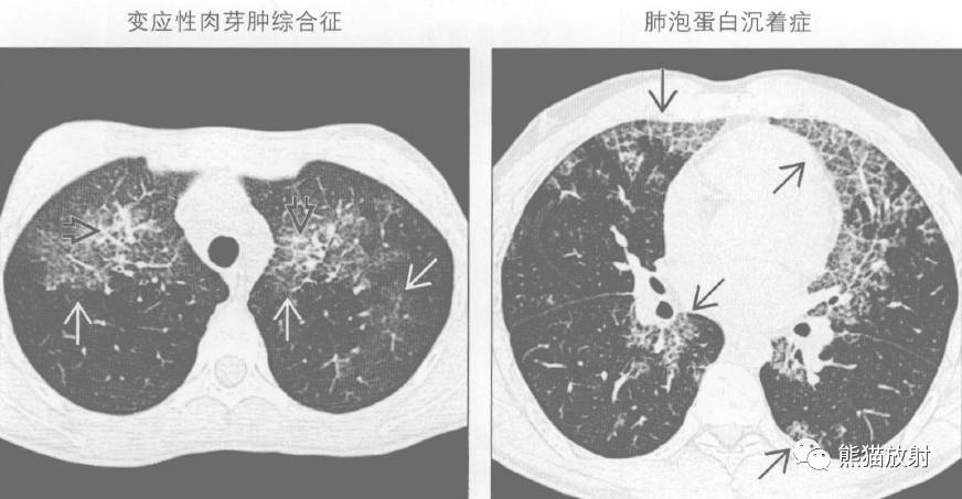 【书摘】急性/慢性肺实变的鉴别诊断