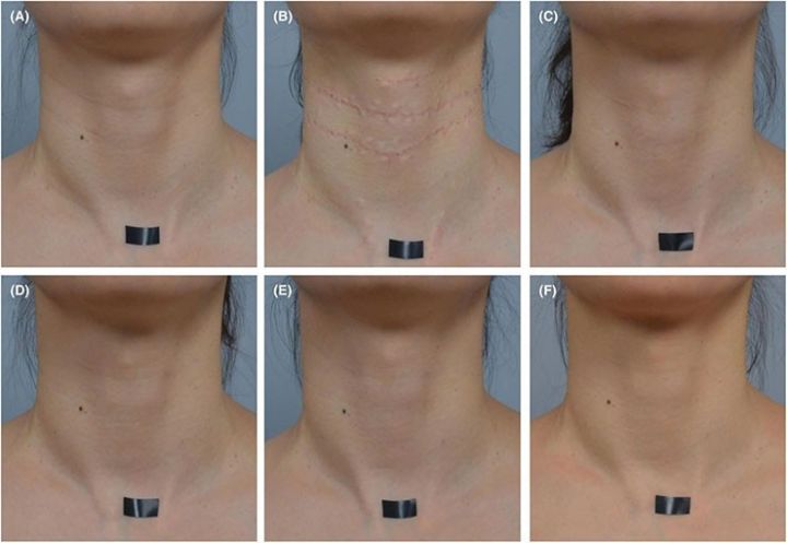 医美圈联合疗法改善亚洲人颈部皱纹高强度聚焦超声透明质酸a型肉毒