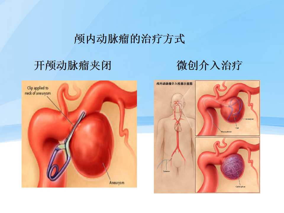 颅内动脉瘤图片高清图片