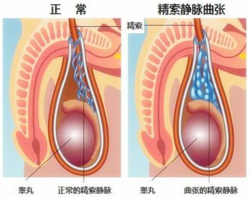 精索静脉曲张的临床表现症状精索静脉曲张为男性精索静脉产生不正常的