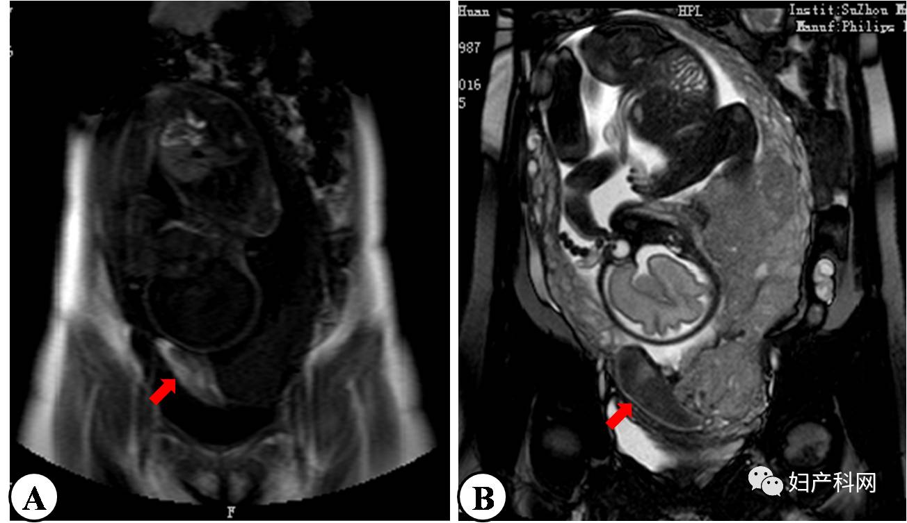 核磁共振胎盘植入图片图片