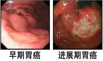 胃癌前期