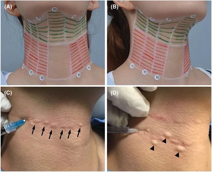 联合疗法改善亚洲人颈部皱纹:高强度聚焦超声 透明质酸 a型肉毒毒素