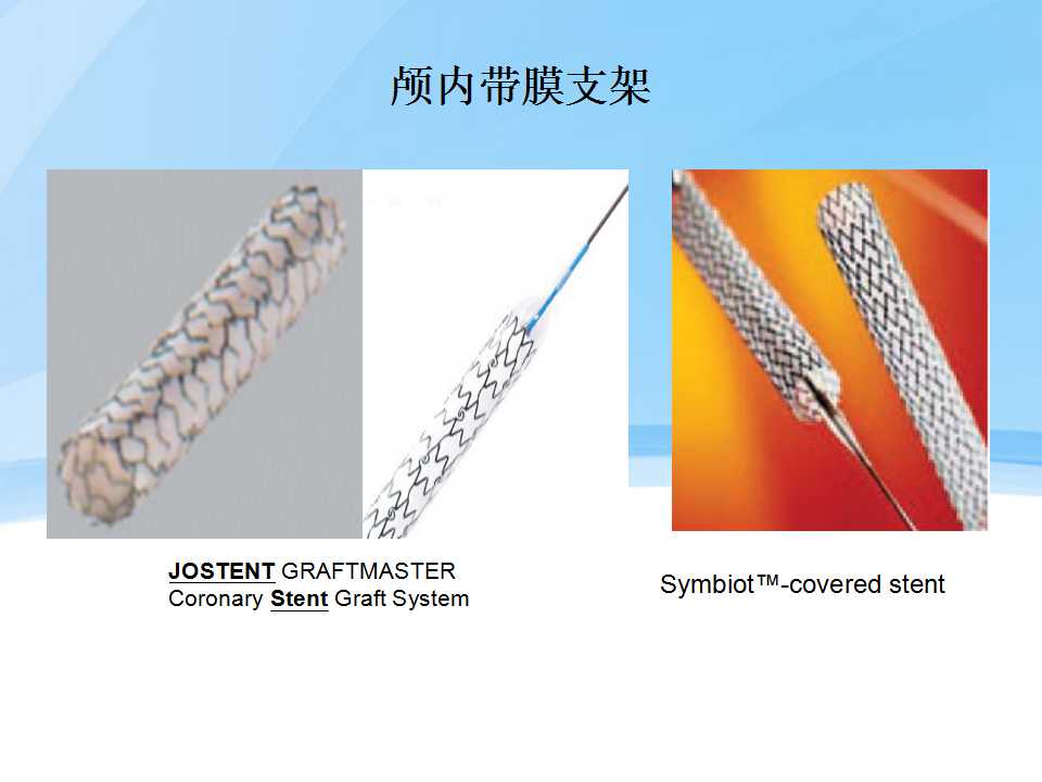 不同类型颅内支架在脑动脉瘤治疗中的应用