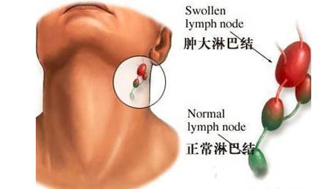 淋巴结肿大保险赔吗 淋巴结肿大保险吗