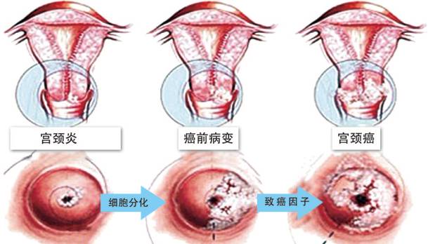 宫颈癌到底离你有多近看完就知道了