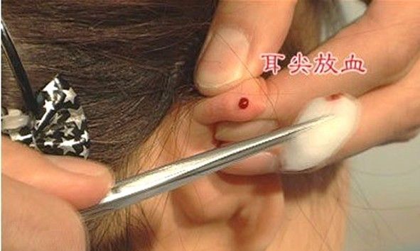 耳廓,使之充血,常规消毒后,用三棱针在选定的耳穴上点刺或划割放血,6