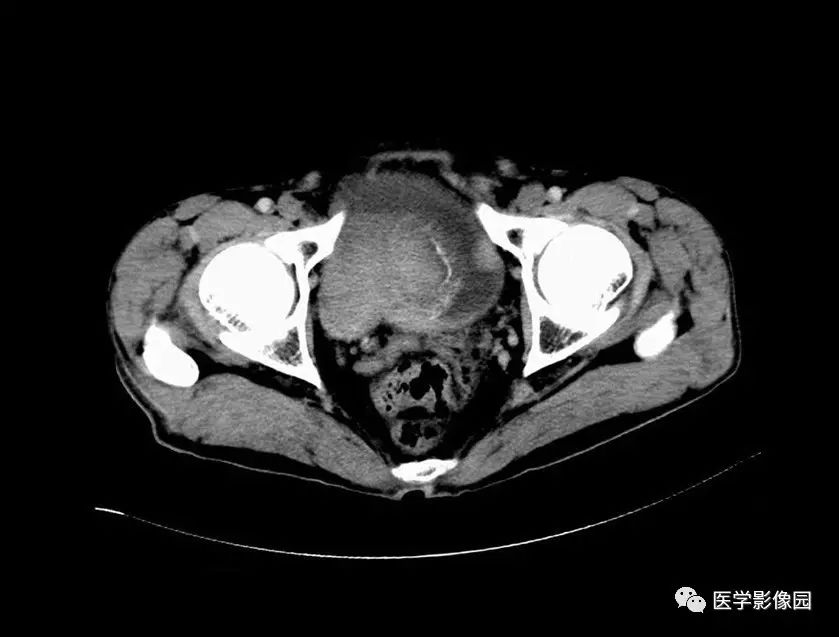 泌尿生殖系統 第二節 泌尿系統病變 二,泌尿系統惡性腫瘤(四)膀胱癌丨