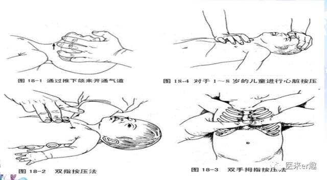 开放气道(a)常用压额抬颏法开放气道,如果颈部有骨折或颈椎损伤,可