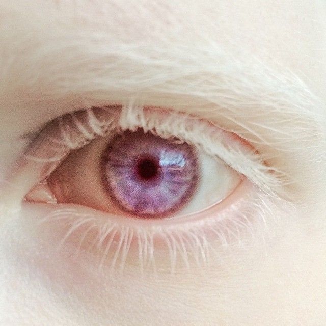 白化病的眼睛颜色图片