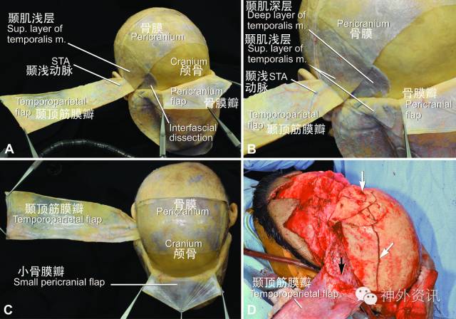 人工骨膜图片