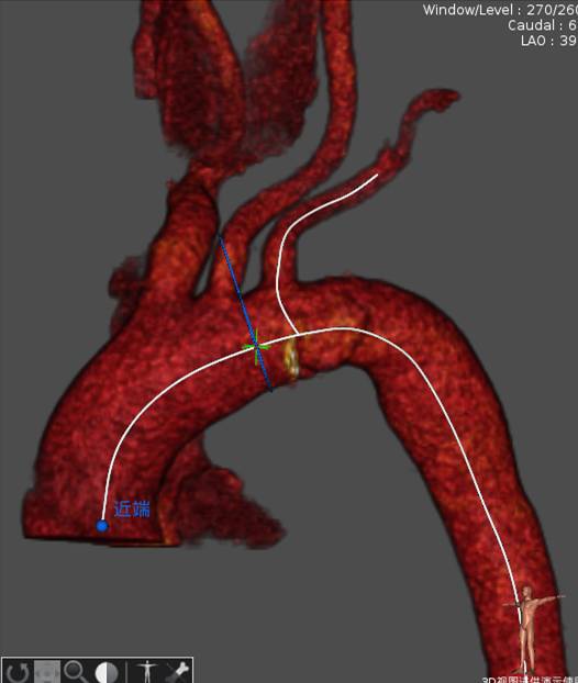 主动脉窦部增宽图片图片