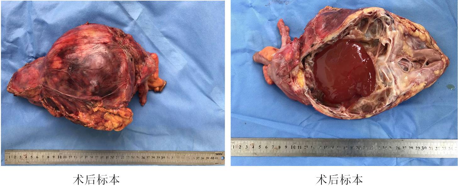 复杂腹膜后肿瘤联合腹腔多脏器及血管切除重建手术病例分享