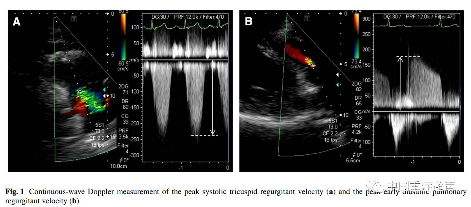 27999948pmid:echocardiography; pulmonary artery pressure