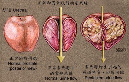 帶你瞭解前列腺