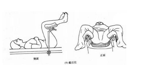 (截石位示意图"平时我们想让他坐在轮椅上,都得拿木棍猛击,关节才能