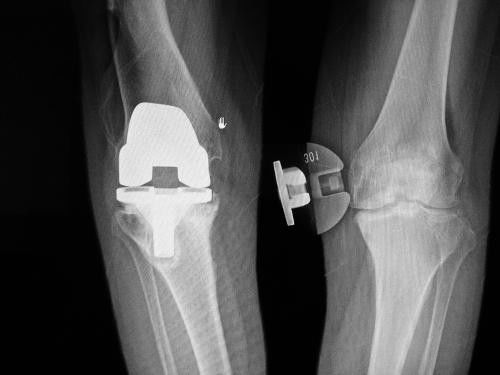 全膝关节置换术的介绍