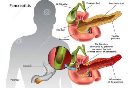 急性胰腺炎病理生理图图片