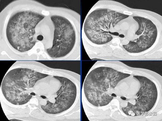 不同类型肺水肿ct表现丨影像天地