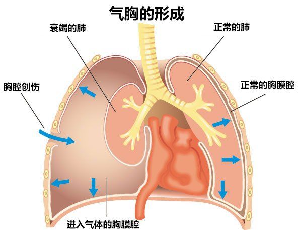 胸腔和肺的示意图图片